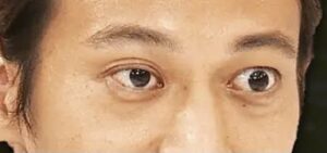 本田圭佑の目が悪化で顔が変わったのはいつから バセドウ病で引退の真相は まるもりジャーナル